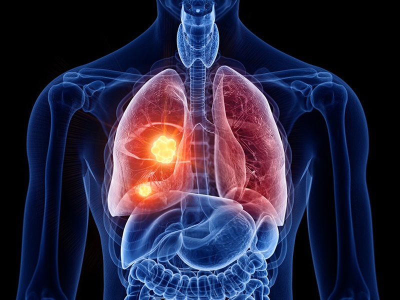 Bệnh bụi phổi gây ra các mô sẹo ở phổi. Ảnh minh họa: Shutterstock